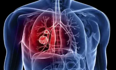 Ceap-Sol destaca a relevância do diagnóstico precoce no enfrentamento da tuberculose