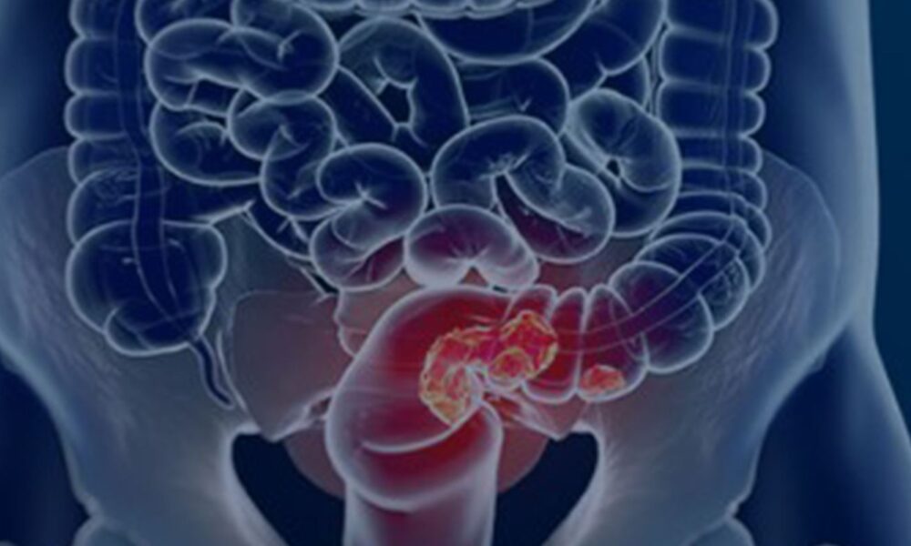 Rastreamento para câncer colorretal pode ser implementado no SUS