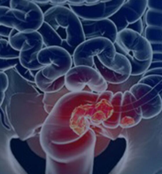 Rastreamento para câncer colorretal pode ser implementado no SUS