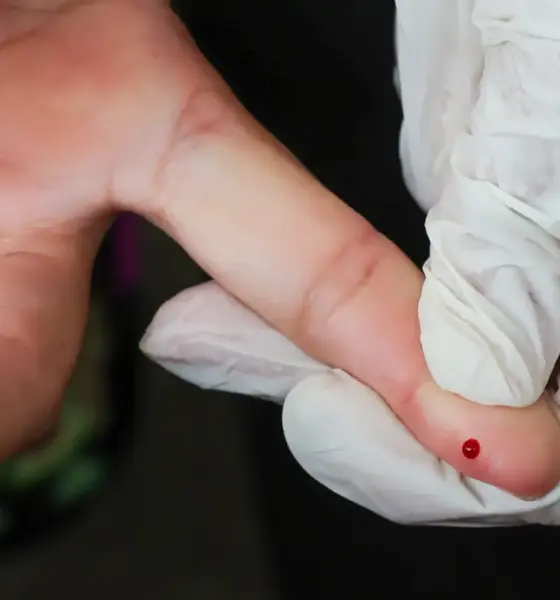 SUS inicia oferta de teste rápido para diagnóstico de dengue