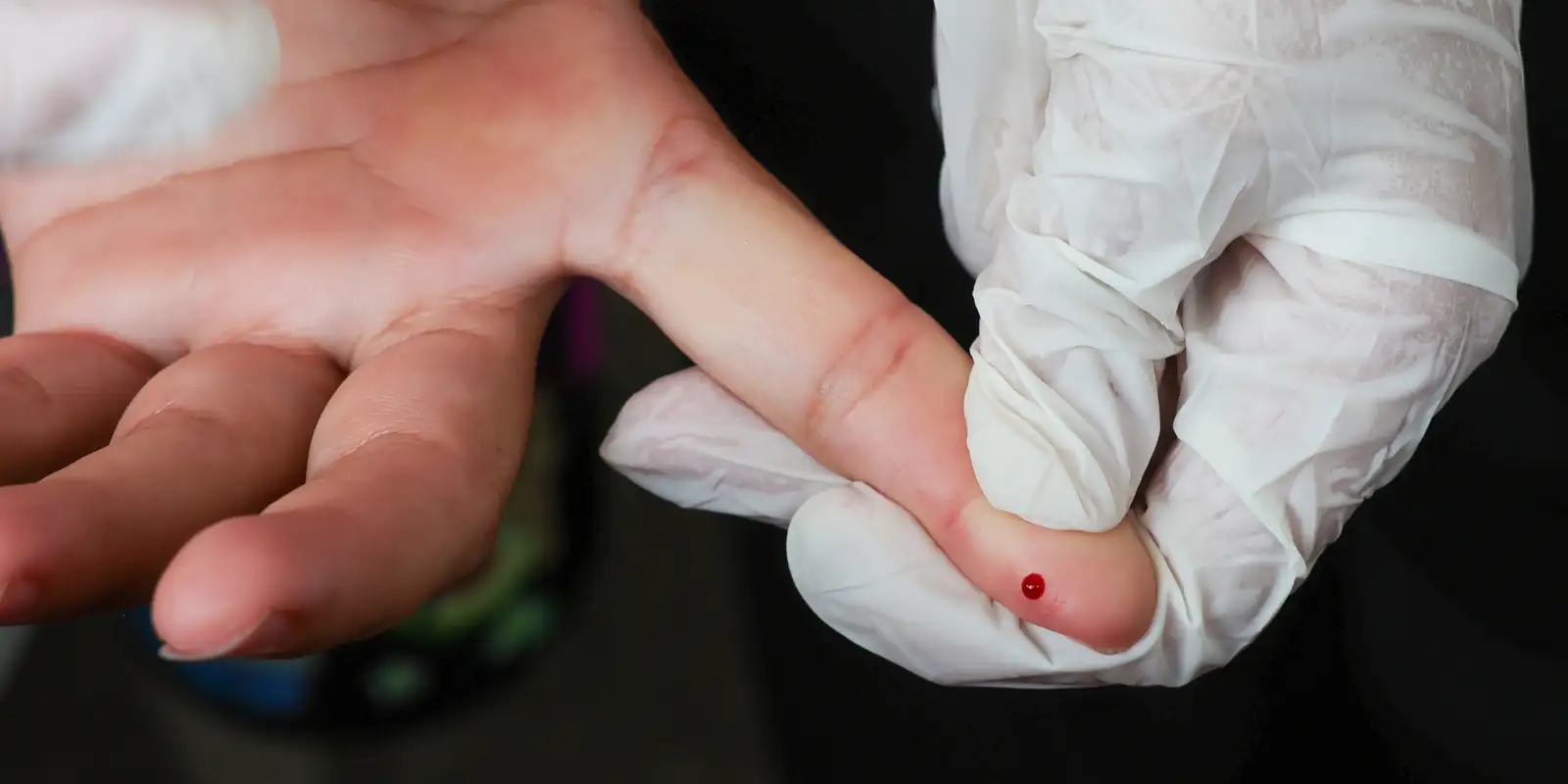 SUS inicia oferta de teste rápido para diagnóstico de dengue