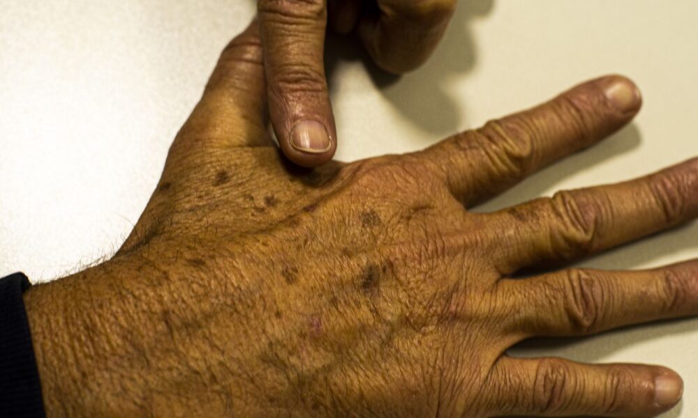 Desinformação sobre câncer de pele impacta diagnóstico, afirma instituição