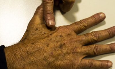 Desinformação sobre câncer de pele impacta diagnóstico, afirma instituição