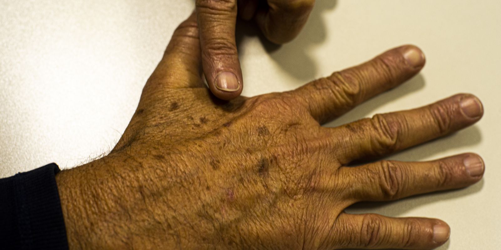 Desinformação sobre câncer de pele impacta diagnóstico, afirma instituição