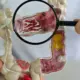 Em 13 anos, doença inflamatória intestinal cresce 5 vezes no Brasil