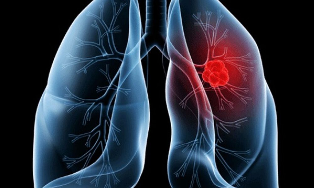 Saiba o que é adenocarcinoma pulmonar, câncer que atinge o papa