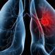 Saiba o que é adenocarcinoma pulmonar, câncer que atinge o papa